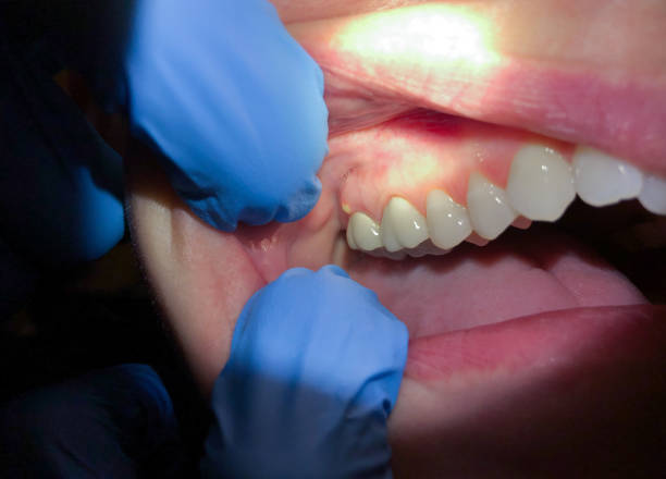 Best Emergency Wisdom Teeth Removal in Oakland, TN